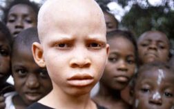 albinism-in-africa